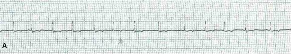 Figure A : lead II Electrocardiogram of uninfected control dogs showing normal sinus rhythm
