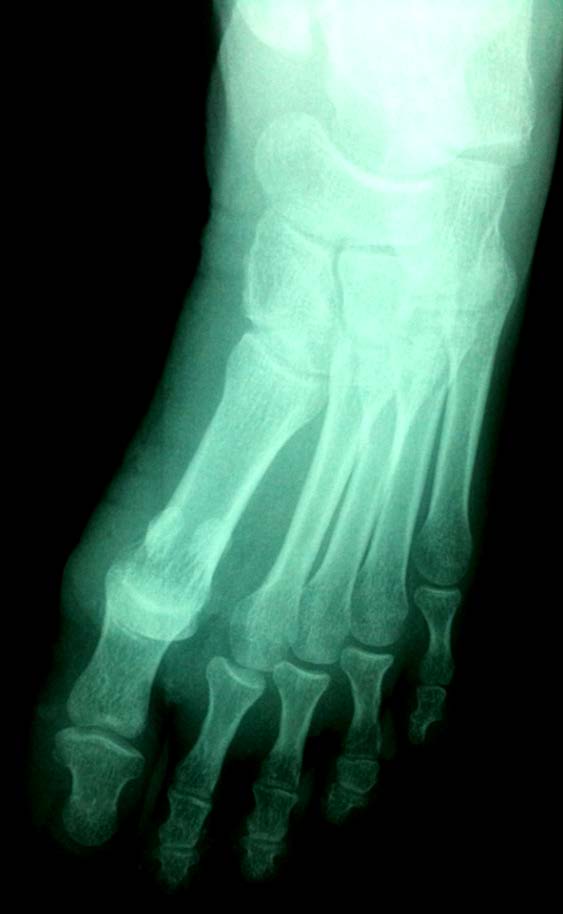 Figure 1 : Radiographs of planto-lateral dislocation of the first metatarsophalangeal joint.