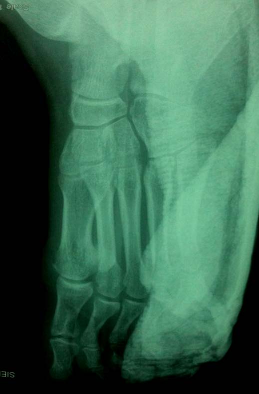 Figure 2 : Radiograph after initial reduction of the first metatarsophalangeal dislocation