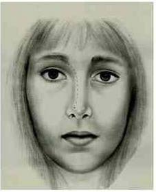 Figure 9 : Transoperative. Dissection with confection ofbi-pedicle flap on the medial and lateral vestibular skin using Converse angled scissor The evaluation of the removed quantity of the cephalic portion of the lateral crus of the LLC isalsomeasured using the same beam compass. The parameterto maintain the cartilaginous arch intact, without interruption, is topreserve 5mm on the medial portion and 7mm on the lateral portion. (Figure 10)