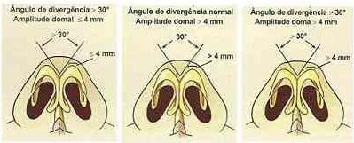 Figure 12 : Transoperative: 3 mm lateral to the dome a sharp needle with a 19mm(PDS®) 4.0 thread is inserted on cephalo-caudal direction in the left LLC