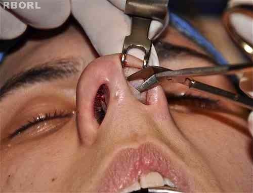 Figure 14 : Transoperative. The maneuver is repeated on the inverse direction, caudal-cephalic, 3mm laterally to the right dome