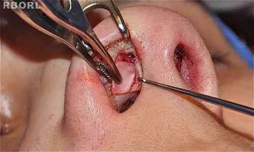 Figure 15 : Transoperative. The same needle is passed through the transfixion incision to the left nasal cavity