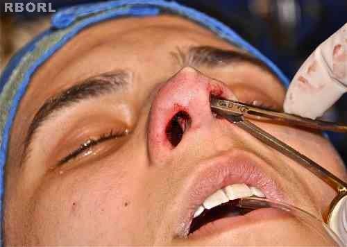 Figure 16 : Transoperative. Hemostatic clamp was used. The not must be centralized on the interdomal space