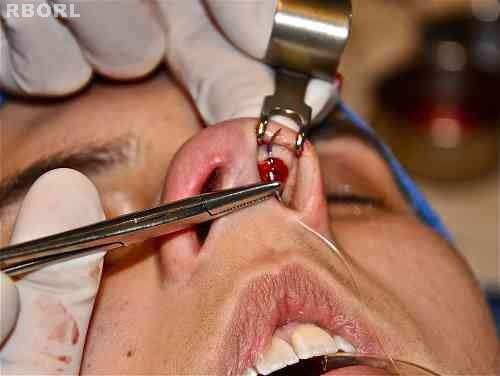 Figure 17 : Preoperative photograph (basal view)