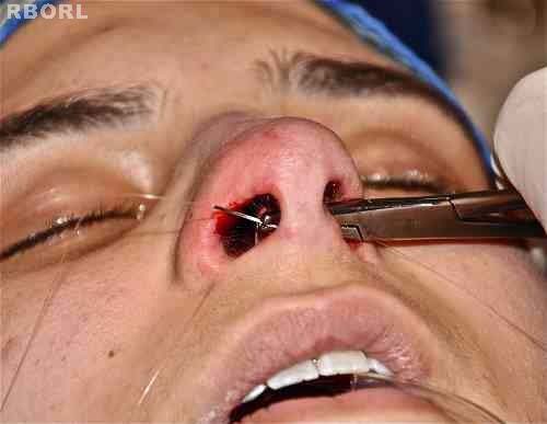 Figure 22 : Post-operative anterior view