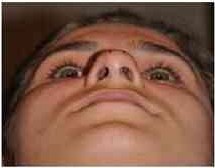 Pre-operative interdomal distance: 54 patients Volume XIV Issue III Version I © 2014 Global Journals Inc. (US) Transoperative interdomal distance: 54 Graphic 5 : Post-operative interdomal distance-after 6 months: 54 patients VI.