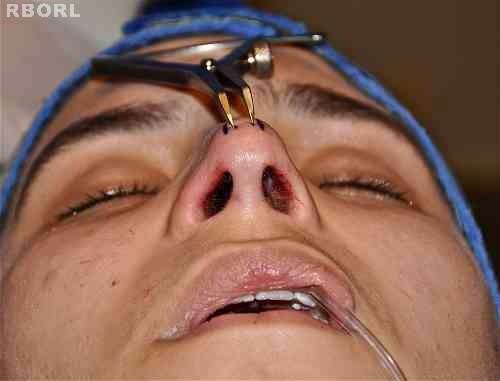 to look for results similar to those obtained through open technique. Indications to closed surgery have increased and are proportional to indications for closed and semiopen technique. The learning curve and the comparison of results in the present study indicates the efficacy of the LIS. Medical literature reports several techniques to structure and definition of the nasal tip, and they can also vary according to the preferences of each surgeon regarding suture threads. We have utilized colorless polydioxanone (PDS®) 4.0 with 19 mm sharp needle that has slow absorption characteristics. Gruber et al. (2008) 30 had effective results utilizingcolorless PDS® 5.0. Tardy and Chemy (1987) 43 on the other hand prefer colorless nylon® 4.0 to redirect the domes of the LLC, but there are no mentions in their studies about this slight compensatory hypercorrection. Volume XIV Issue III Version I © 2014 Global Journals Inc. (US)