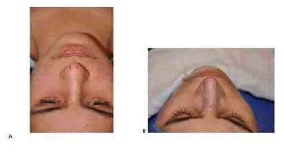 1 mm at the sixth month of post-operative period, confirming this report. About open access, Gruber et al. (2008) 30 concluded that the suture between the LLC is more precise, however they do not reject closed rhinoplasty technique or semi-open technique (Guyuron; Behmand e Ramin, 2003) 350 with similar results. In the present study all LIS were performed using endonasal technique.