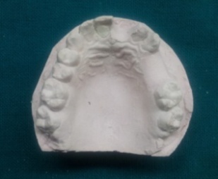 Figure 3 : Arranged acrylic teeth in edentulous areas 3. On the presurgical cast, remove one by one the teeth which in later stage is planned to be extracted during the maxillectomy procedure. 4. Arrange prefabricated acrylic teeth on the edentulous area duly created by removal of anterior teeth.(Fig.4)