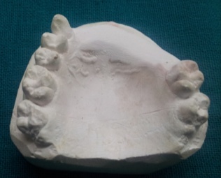 Figure 9 : Periphery secured and blocked with sticky wax 14. Pour a liquid mix of clear autopolymerizing resin (Palapress vario; Heraeus Kulzer Co) at a powder ; liquid ratio of 10g to 7 ml through the stainless steel mould attached to the matrix (Fig.10)