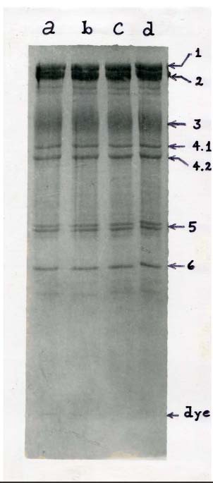 Figure 2 : Low power view showing mixture of chondrosarcomatous and carcinomatous foci (H&E 100X)