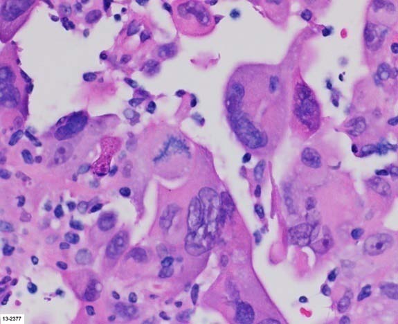 Figure 6 : Napsin A: focal positive cytoplasmic staining, a specific marker for primary adenocarcinomas of lung