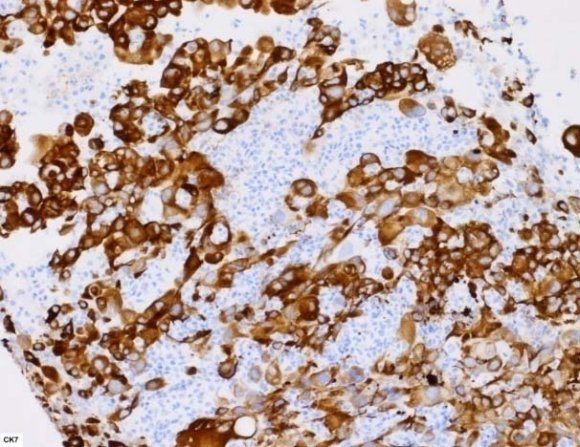 Addis et al., suggested that giant cell carcinoma arises by a process of dedifferentiation with eventual loss of epithelial markers showing unique ultrastructural features that Volume XIV Issue VIII Version I Year 2014 © 2014 Global Journals Inc. (US)