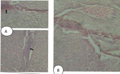 Figure 2 : A. Fluke's migratory tract infiltrated with macrophages and eosinophils, and few neutrophils (arrows), B. Chronic liver fasciolosis with portal fibrosis (H and E, 40x) c) Serum Biochemical Analysis Serum biochemical parameters were compared among animals with no visible gross lesion and no liver fluke (group A), fasciola indicative lesions and fasciola presence (group B), and liver fluke, liver fluke indicative lesions together with other non fasciola like lesions/ coinfected (group C) (Tables 4, 5 and 6). When comparing mean values with that of group A, animals with acute fasciolosis and hepato-necrosis have significantly elevated activity of serum ALT and AST (Fcalcul.>Ftabul.; P<0.05). However, cases with chronic biliary cirrhosis showed decreased ALT and AST activity. In cattle AST and ALT were statistically higher in animals with hepatocyte degeneration, and eosinophilic hepatitis but ALP was significantly increased (Fcalcul.>Ftabul.; P<0.05), in animals with cholangitis and biliary fibrosis. Similar serum biochemical changes were observed in sheep and goats. The serum liver AST, ALT and ALP activities were also positively correlated (0<r<1) with pathologic lesions (Tables 3, 4 and 5).