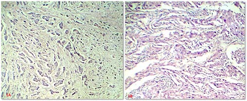 Figure 1 (A): Infiltrating Ductal Carcinoma-grade II (H&E, 100X) Figure 1 (B): Infiltrating Ductal Carcinoma-grade III (H&E, 100X) Figure 2 (A): ER positivity (Nuclear) -IHC (400X) Figure 2 (B): PR positivity (Nuclear) -IHC (400X) Figure 2 (C): BRCA 1 positivity (Nuclear) -IHC (100X) Figure 2 (D): BRCA 1 positivity (Nuclear) -IHC (400X)