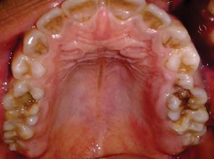 Among the twenty cases reviewed in our study, there were 2 cases diagnosed to have lymphoma (fig 8); MSCT revealed huge anterior mediastinal mass, displaced and compressed SVC with no collaterals. These findings are not consistent with the study made by Kantarci et al, 2008 which presented multi-detector row CT (16-detector scanner) features of a case of SVC syndrome caused by compression of lymphadenopathies at Hodgkin lymphoma of an 8-year-old girl. Her chest radiograph showed mediastinal enlargement and computed tomography of the chest showed massive mediastinal lymphadenopathy, axillary adenopathy, and bilateral pleural effusions. Multi Slice Computed tomography showed no contrast within the SVC and contrast within enlarged collateral venous channels of the left chest and no channels on the right because of the right subclavian venous occlusion (22). C Clinical Data 17 year-old female patient known Hogkin's lymphoma. MSCT CECT chest axial image mediastinal window showing huge anterior mediastinal mass compressing and posteriorly displacing SVC. Case 9 Clinical Data 37 year-old female patient with left upper limb DVT. MSCT CECT chest axial images mediastinal window showing the swollen non enhanced left brachiophephalic vein with normal right brachiocephalic vein and SVC. Osman Temizöz et al, 2010 reported a 50-yearold female patient with BD who was admitted to hospital with a 4-week history of persistent dyspnea and chest pain. Physical examination revealed swelling of the neck and upper extremities. In addition, there were visible venous collateral channels, particularly on the right lateral side of her upper trunk. A clinical diagnosis of SVC syndrome was made, and MDCT of the chest and abdomen revealed occlusion of the SVC. The dilated right lateral chest wall veins were seen as collateral channels crossing the right diaphragm The azygos and hemiazygos veins were also dilated. These findings are more or less consistent with our study having 5 cases of Behcet's disease; their CT scans revealed eminent mediastinal collaterals with prominent azygos vein (23).