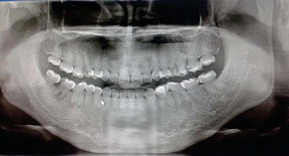 the Investigation of Bacteria-Nanoparticles Interactions Sub-Cellular