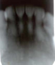 Figure 10 : Scheme of the absorption of polyurethane nanoparticles by S. aureus