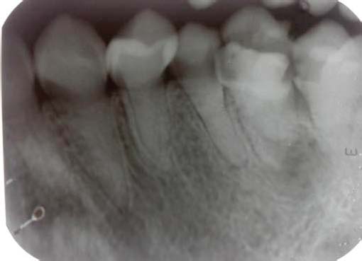 2012; Didenko et al., 2013; Curia et al., 2013; Curia et al., 2014]. Bacteria loaded with nanoparticles, while attacking the host cells (Fig. 11) of an organism of an organisms following their natural path [Lowy, 2000; Malani, 2014; Sansonetti, 1993], carry nanosized particles to numerous zones of the body, acting as Trojan Horses. Indeed they hide nanoparticles and, once reached the target, , S. and Ewing, R. C. (2003) "Application of high-angle annular dark field scanning transmission electron microscopy, scanning transmission electron microscopy-energy dispersive X-ray spectrometry, and energy-filtered transmission electron microscopy to the characterization of This work illustrates explains how much electron microscopy can contribute in the research of the consequences of biodestruction of medical prostheses operated by bacteria and in the resultant spreading of nanoparticles.