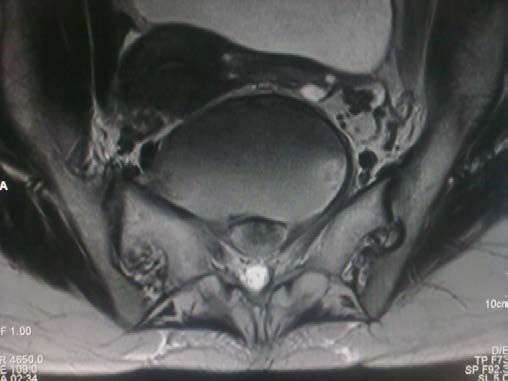 Figure 2B shows calcified larvae in paraspinal muscles and gluteal muscles