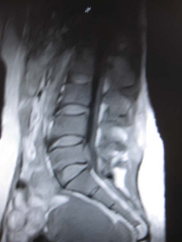 1 at L5/S1 a period from June, 2009 to November, 2009. All patients were evaluated in detail by clinical and spine examination prior to MRI lumbo-sacral region. The eligibility criteria included (a) the chief complaint of LBP