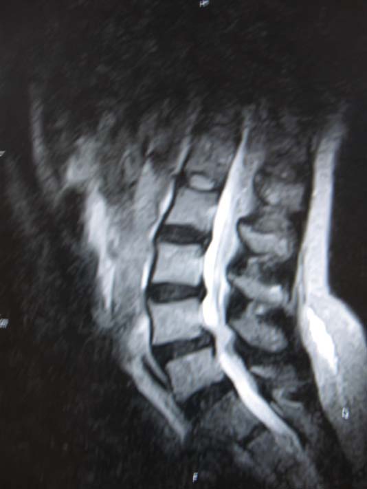 II Version I © 2011 Global Journals Inc. (US) Evaluation of Pattern of magnetic Resonance Images of Lumbo -Sacral Spine in Camernoon -A Pioneer StudyEpidural Fibrosis :Spondylosis :
