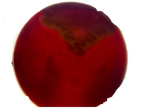 Figure 3 : Vesicular lesions on feet