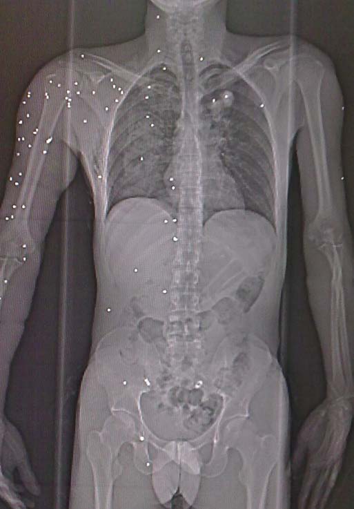 Figure 1 : Pellet Injuries in Limbs, Neck, Thorax and Abdomen
