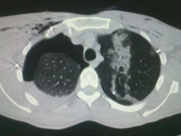 Figure 2 : Pellet Injuries in Lungs
