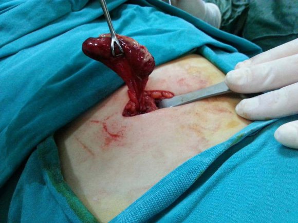 Figure 1 : Penetrating abdominal stab.1a.No disembowelment (negative laparoscopy);1b. Omentum sticking out (laparoscopy guided hemostasis)