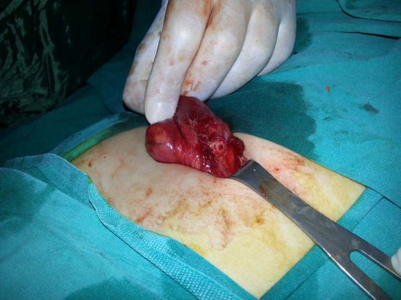 Pattern of Neonatal Surgical Presentation and Outcome in Sinnar Hospital (2013-2014) Volume XIV Issue IV Version I © 2014 Global Journals Inc. (US) not be generalized for the whole population thus further wide-scale surveys are needed.