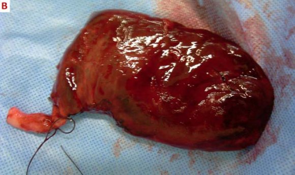 Figure 2 : Intraoperative cholangiography shows the long cystic duct with no stones in common bile duct II.