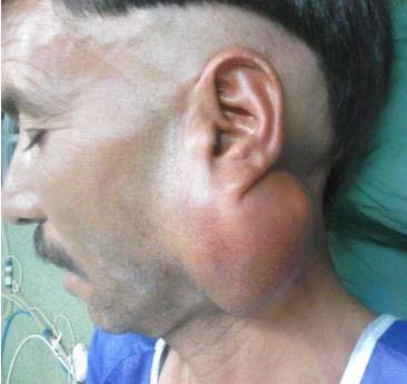 Figure 3 : FNA (fine needle aspiration) smears of parotid mass e) Treatment and follow-up