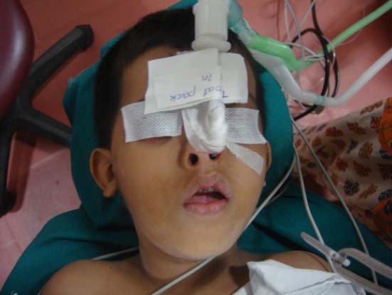 Bohemia, NY) No cleft lip/palate and/or other craniofacial syndromes ; All selected subjects are Saudi descent; Cephalometric skeletal landmarks used in current study: Fig (1) N-S -ANS -PNS -A -B -Pog-Me-Ar-Go-Bo -Ao.