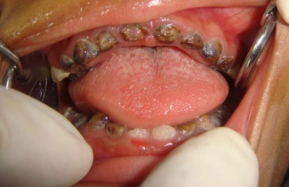 Figure 1 : Cephalometric Skeletal Landmarks used in the Current Study Cephalometric dental and soft tissues landmarks used in the current study:Fig(2) UI-APUI -LI -APLI-Pog'-Li-LS -Sn -Pn.