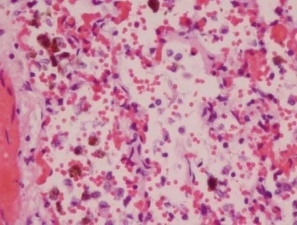 Figure2: Fluorometry Results by Organ. Extracted mycotoxins from tissue with paraffin embedded blocks. Grind Tissue, Blend sample with PEG, Pass through column, Wash with tween and water, Elute Antigen (i.e. T-2) from column with methanol, Use calibrated fluorometer, Results are reported as present in parts billion (ppb)