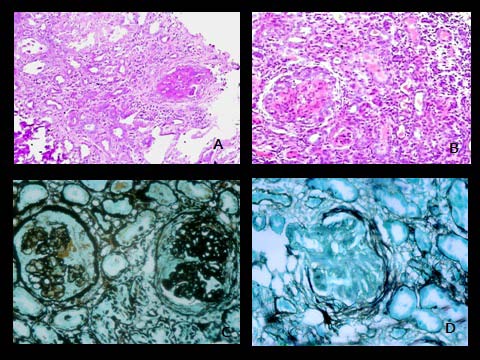 Figure 1 : Morphological spectrum of various crescentic glomerulonephritis Figure1 A : A cellular crescent showing central fibrinoid necrosis in a case of ANCA positive case. (H & E 200 X) Figure1B: A cellular crescent in a case of rapidly progressing glomerulonephritis (RPGN). (H & E 200 X) Figure1 C : Negative shadow of a cellular crescent and sclerozed capillary loops on silver stain in a case of RPGN (PMS 400 X) Figure1 D : Few reticulin positive fibres noted in a fibrocellular crescent on silver stain in a case of RPGN (PMS 400 X)