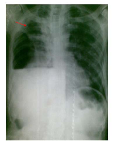 (Serrano & Conejero) Whereas the clinical diagnosis of PAD is dependent on the vascular history, the epidemiologic studies have implied the Global Journal of Medical Research © 2015 Global Journals Inc. (US) 14 Volume XV Issue 1 Version I Year 2015 multisystemic involvement of vascular disease and it is usual to find coronary or cerebrovascular disease in patients with vascular disease.