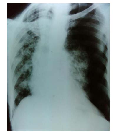 artery occlusive lesions. Stent placement should be reserved for angioplasty failures. However, primary stent placement is indicated in total occlusions. TASC lesions type A and B are best treated with angioplasty and stenting, while TASC lesions type C and D show better results with surgical treatment.(Brountzos)