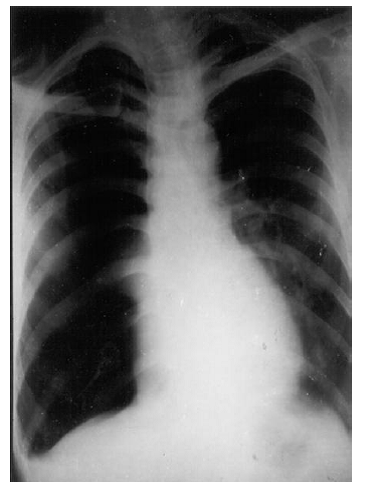 a) Things To Look For On The SAME SIDE Of Pneumothorax 1. Air in soft tissue: Surgical emphysema (due to the cause of pneumothorax or introduced during the insertion of the intercostal tube. 2. Rib fracture: Traumatic (including pathological fractures) 3. Intercostal tube May indicate severity and also suggest as coexisting empyema or haemothorax. May be the source of air. 4. Costophrenic angle obliteration (suggesting associated pleural effusion+ Hydropneumothorax Fluid level 5. Is the collapse of the lung complete Collapses like a ball to hilum (major underlying lung disease in the almost completely collapsed lung is unlikely. 6. Is the collapse of the lung partial? There must be some reason for preventing complete collapse: Look Outside the lung for: Fibrous strands , small pneumothorax. Look Inside the lung for: T. B. infiltration, malignancy. 7. Pleural thickening Old lesion.
