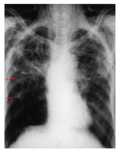 Figure 2 : Observe 1. Surgical emphysema on both sides. 2. Pneumothorax on the right side. 3. Intercostal tube on the right side. 4. Calcification on left side indicating possible old tubercular foci. i. Observe ? Chest tube -used to treat the pneumothorax.
