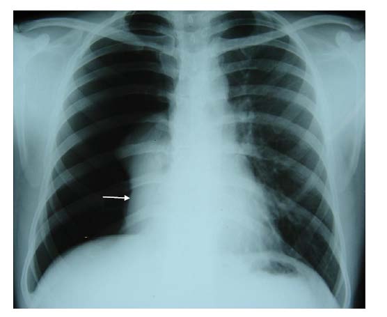 Figure 3 : In see the collapsed lung. Lung tends to collapse like a cricket ball towards the hilum (compression collapse). Unlike the x ray in fig 1, the lung has failed to collapse to the hilum indicates the possibility of an underlying pathology.