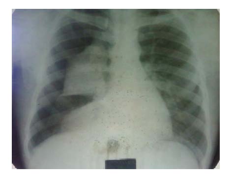 Figure 6 : Observe in figure 6 that the lung underlying the pneumothorax on the right side has partially collapsed.