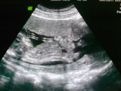 a) Preparation and procedure for termination of pregnancy Laboratory processing of pregnant women: Blood type: 0 Rh D + (positive). Hematological analyses: WBC 5.4 x 109 / L, Neutrophil granulocytes 58.1%, 29.8% Lymphocytes, Erythrocytes 3.74 x 1012 / L, Hemoglobin 118 g / L, Hematocrit 0.34 L / L, Thrombocites 204 x109 / L. Biochemical analysis: Glucose 3.8 mmol / L, Urea 2.1 mmol / L, Creatinine 55?mol / L, Uric acid 182?mol / L, C-reactive protein (CRP) 5.1 mg / L, Fibrinogen 3.6 g / L. Coagulation status factors: Prothrombin time (PT) -10.3 sec., International Normalized Ratio (INR) 0.91, Activated partial thromboplastin time (Activated partial thromboplastin time-APTT) 26.0 sec. Jonogram: Potassium 4.0 mmol / L, Sodium 137 mmol / L, Calcium 2.14 mmol / L, Magnesium 0.88 mmol / L, Iron 19.1 mmol / L. Alpha-fetoprotein (AFP) 55.74 IU / mL Urine analysis: Finding is normal.