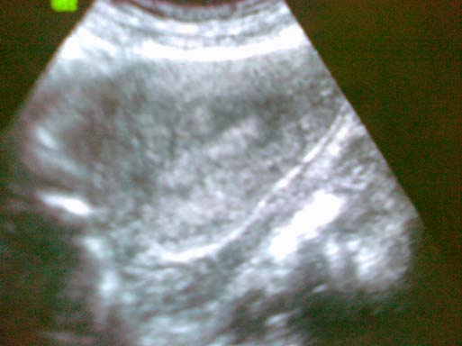 Figure 3 : Ultrasonographic view of the uterus at the patient's discharge from hospital.