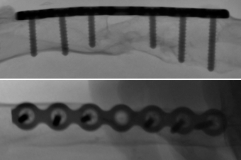 Figure 2 : In native radiographic terms, the fracture cleft appears closed (upper picture lateral projection, lower picture ap-projection, sinistral distal, dexter proximal)