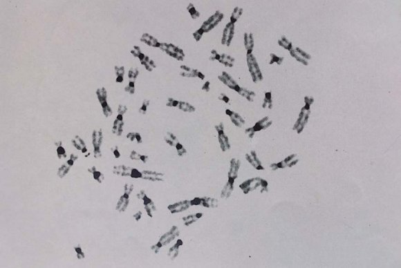 Figure 1 : Chromosomal C-heterochromatin regions (C-HRs) of the human karyotype after C-staining. C-HRs (dark bands) is located on all human chromosomes.