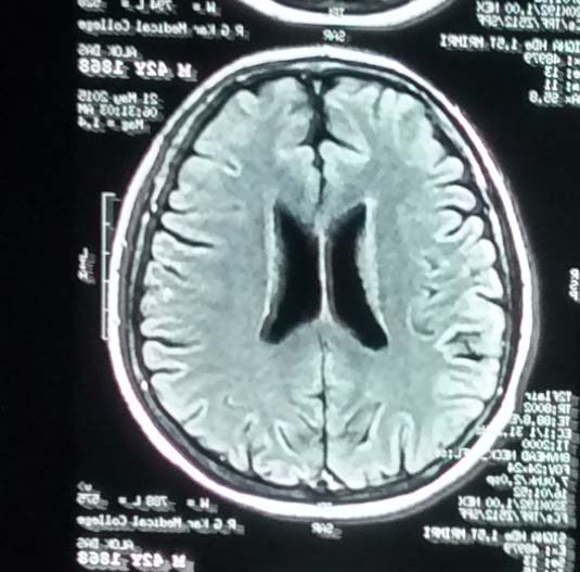 . The ESS scores used to evaluate the improvement in most parameters Volume XV Issue II Version I Year 2015 ( )