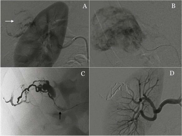 Conclusion: Double-lumen balloon microcatheter Onyx embolization is feasible and safe in peripheral interventions, lowering the potential complications related to reflux or Onyx migration.